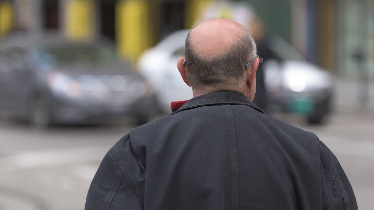 trapianto di capelli